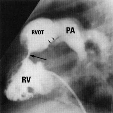 Lateral right ventriculography of a patient with d