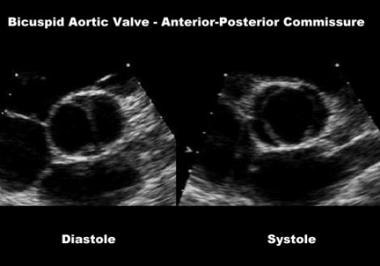 Bicuspid Aortic Valve. Two-dimensional echocardiog