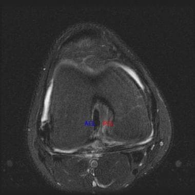 This transverse MRI shows edema to the torn poster