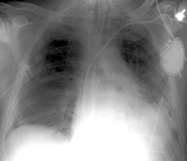 Bilateral airspace infiltrates on chest radiograph