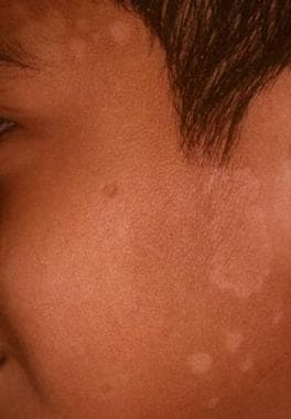 Is facial contraindicated for tinea versicolor (pityriasis versicolor)?