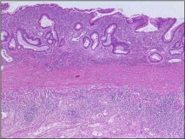 Histologic features of chronic colitis with crypt 
