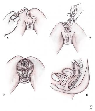 Pediatric Rectal Prolapse Treatment & Management: Approach Considerations,  Manual Reduction, Conservative Management