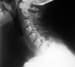 Cervical Spine Acute Bony Injuries in Sports Medicine