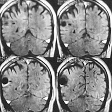 Case 3: MRI of a 47-year-old man with 2 right pari