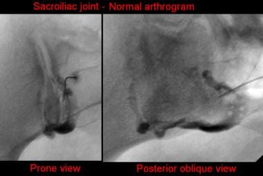 Sacroiliac joint, normal arthrogram. Left side is 