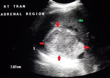 This image shows a relatively large right adrenal 