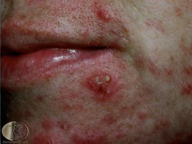 Acne, Rosacea, and Other Acneiform Conditions