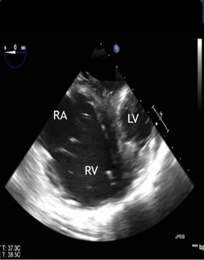 Emergency transesophageal echocardiogram shows dil