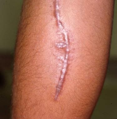 Hypertrophic scar. 