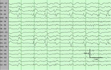 Periodic lateralized epileptiform discharges (PLED