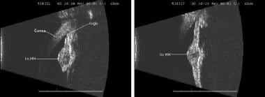 High-resolution B-scan images of an iris melanoma.