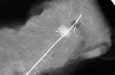 Overview: Breast – Localization & Treatment Procedures in Radiation Therapy