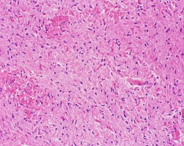 Rosenthal fibers are elongated, eosinophilic, prot