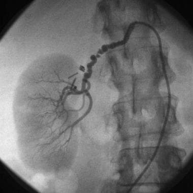 Preangioplasty angiogram obtained in young woman w