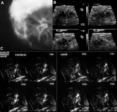 Breast Ultrasonography: Practice Essentials, Technique, Invasive  Ultrasonography