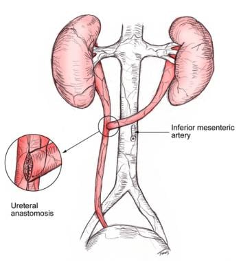 Transureteral ureteroureterostomy. 