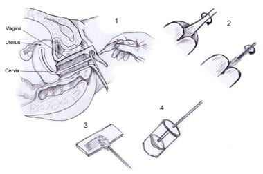 pap smear procedure steps