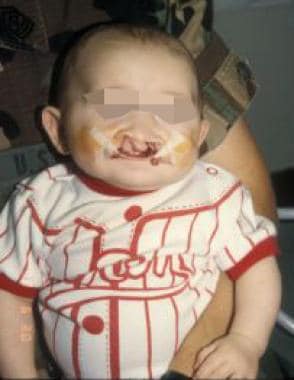 A child with bilateral cleft lip and palate being 