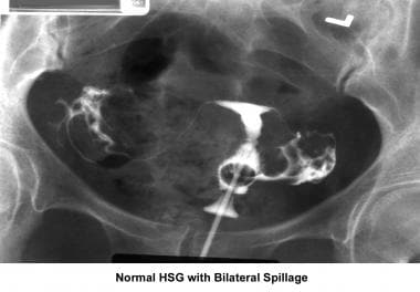 Infertility. Hysterosalpingogram image demonstrati