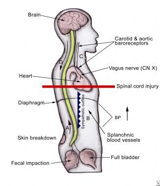 Autonomic Dysreflexia in Spinal Cord Injury: Practice Essentials,  Pathophysiology, Causes of Autonomic Dysreflexia