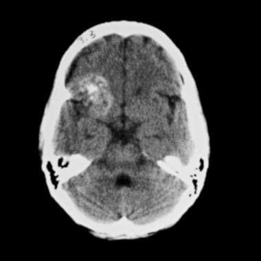 Large, right frontal and left occipital cavernous 