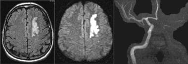 Left internal carotid artery (ICA) occlusion: Axia