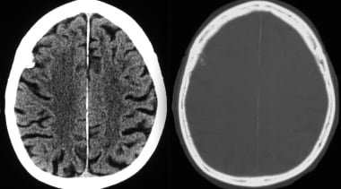 Transverse axial CT at the level of the centrum se