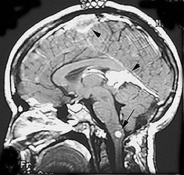 Sagittal T1-weighted postcontrast image in a patie