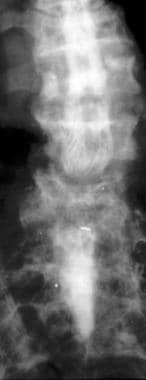 Anterior view of a lumbar myelogram demonstrates s