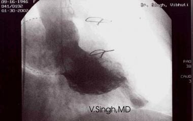 Mitral regurgitation as seen with left ventricular