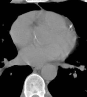 Coronary artery calcification - CT. Section caudal