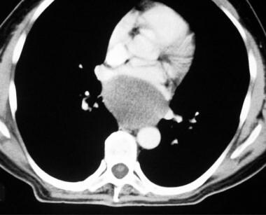 Bronchogenic cyst. CT demonstrates a subcarinal ma
