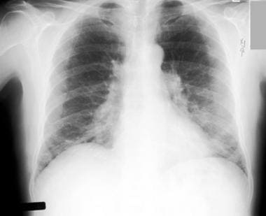 Chest radiograph in a 60-year-old dairy farmer who