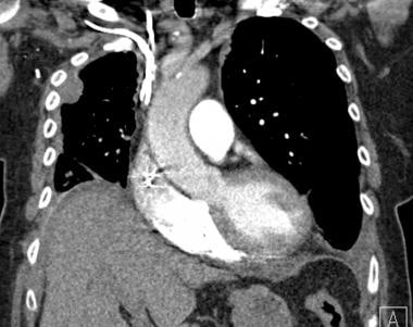 Coronal contrast CT scan in a patient with breast 