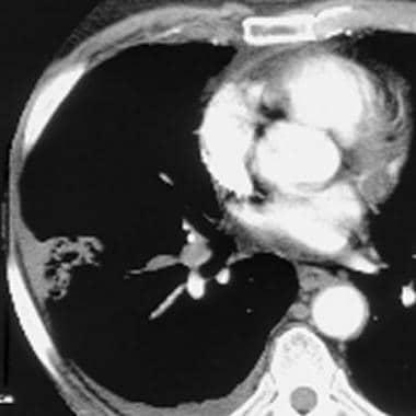 Computed tomography angiogram in a 53-year-old man