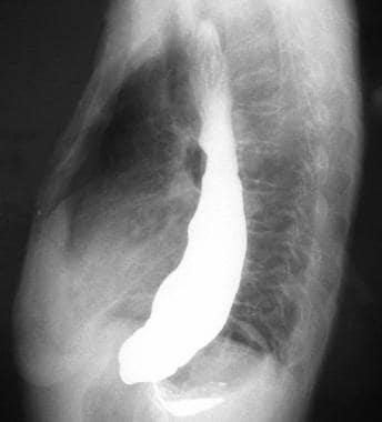 Lateral view from a barium swallow study demonstra