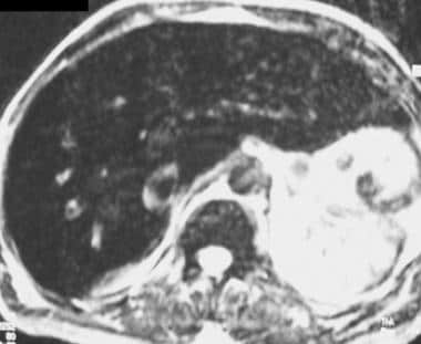 T2-weighted spin echo image in a 47-year-old man w