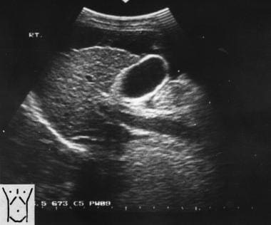 Sagittal oblique sonogram of the liver shows a sma