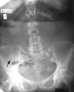 An erect plain abdominal radiograph of the abdomen