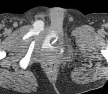 Urethra, trauma. CT scan shows contrast material i