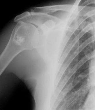 Plain radiograph in a middle-aged man with shoulde