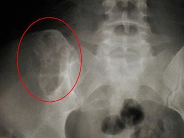 Radiograph of the right sacroiliac joint of a 20-y