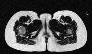 T2-weighted axial image showing a heterogeneous hi