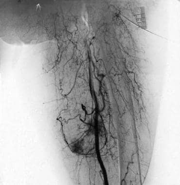 Angiogram reveals tumor hypervascularity (same pat