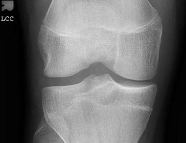 Anteroposterior radiograph of the knee is unremark