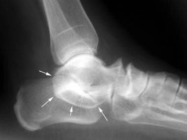 Talocalcaneal coalition. Lateral radiograph of the