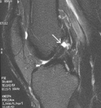 Chronic tear of the ACL with proximal, focal hyper
