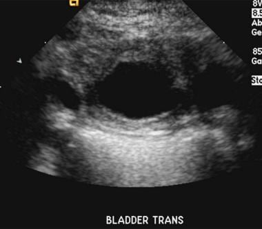 Transverse sonogram in a boy with grade V vesicour