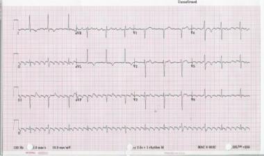 Twelve-lead ECG of type I atrial flutter. Note neg